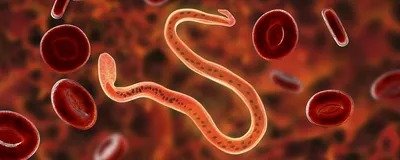 Premier Nation | लिम्फेडेमा रोगियों की पहचान और ग्रेडिंग को लेकर आयोजित...